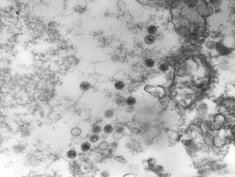 Epstein-Barr-virus-EBV